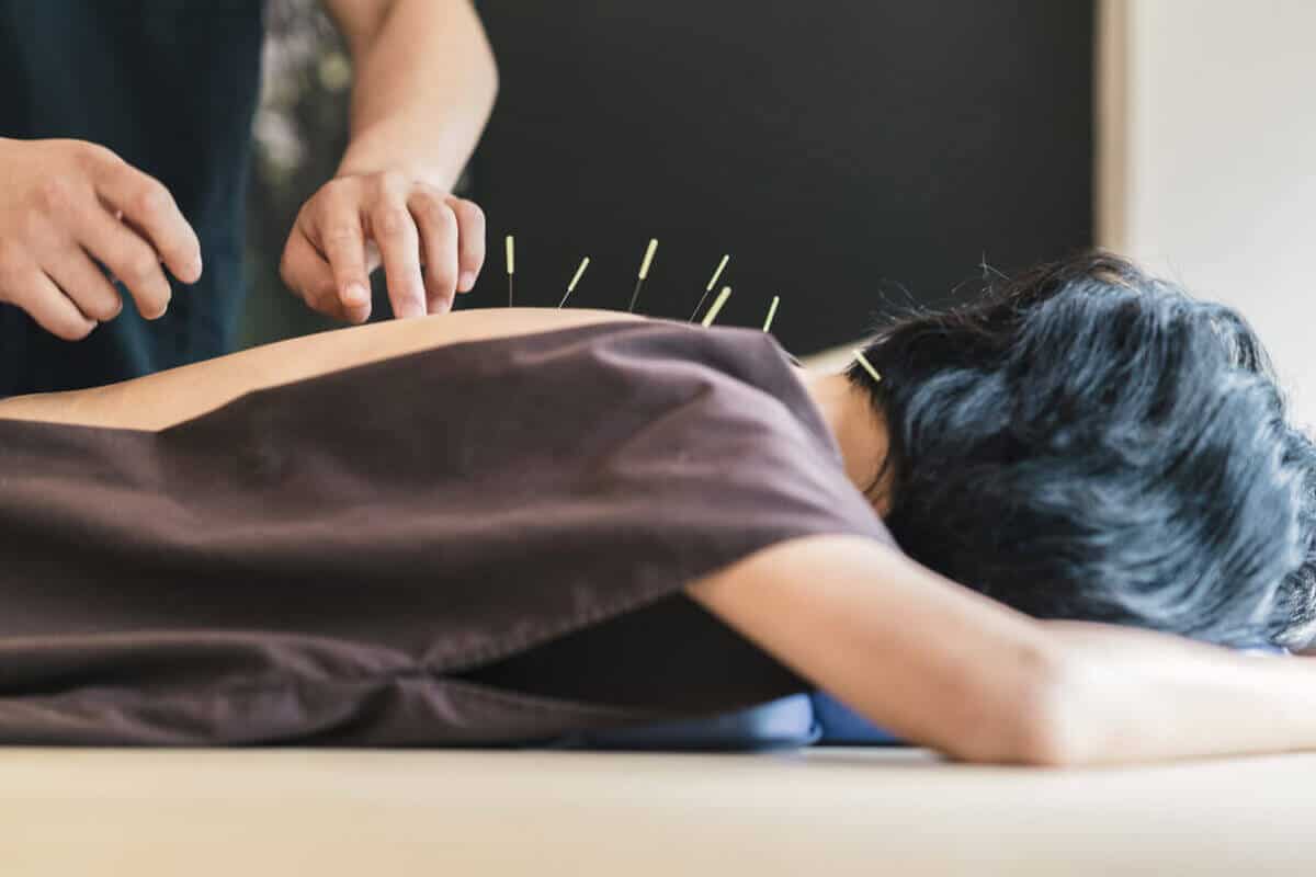person getting acupuncture done on them by a practitioner