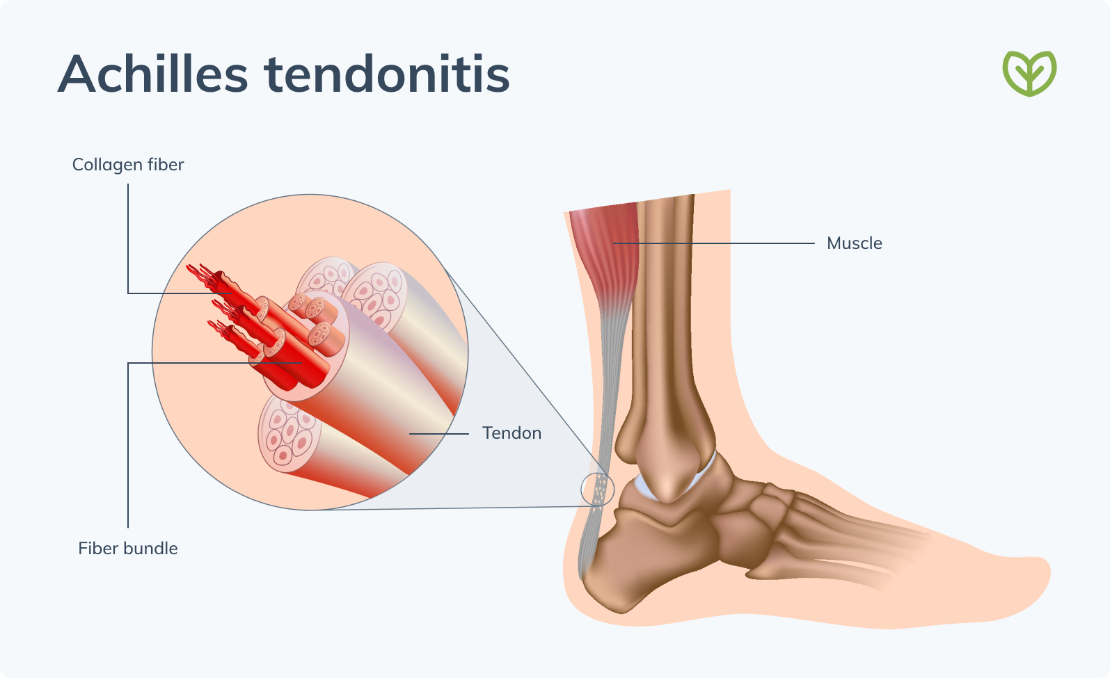 how to treat tenonitis achilles tendonitis