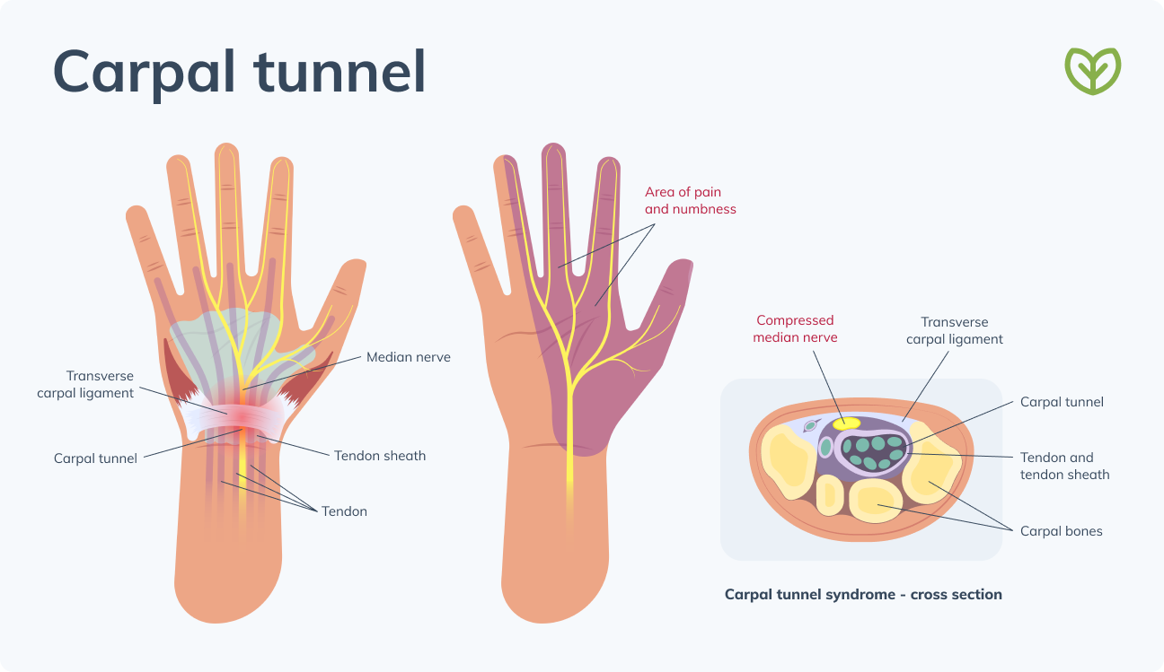 carpal tunnel syndrome exercises carpal tunnel diagram