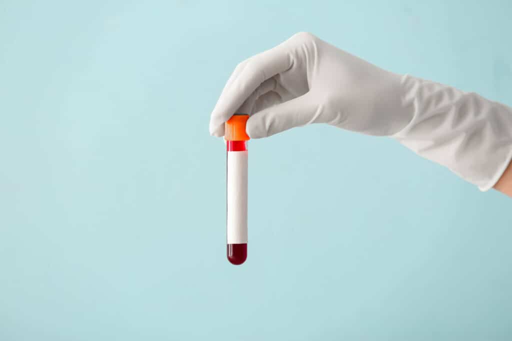 graves disease vs hashimoto hand holding a test tube
