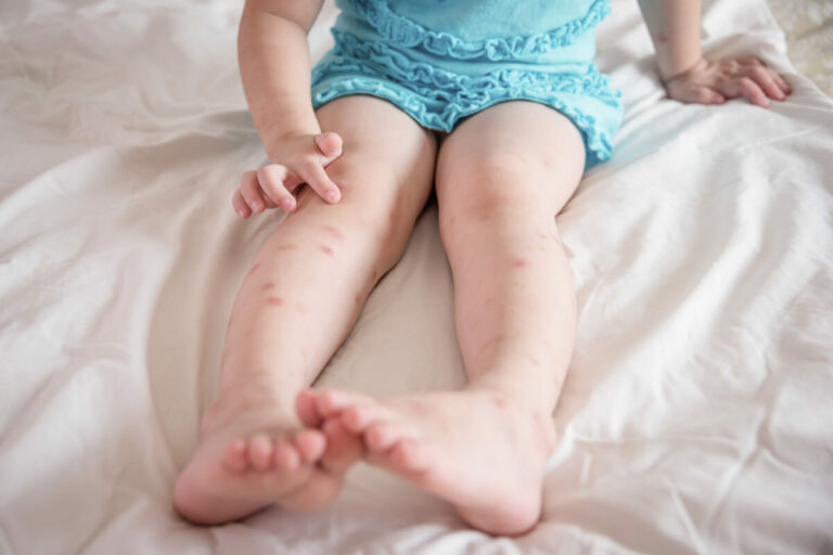 natural bug bite relief: 5 home remedies for itchy skin blog post