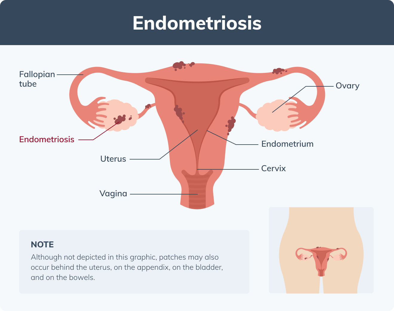 endometriosis diagram