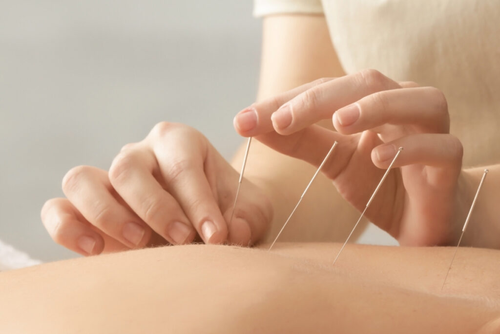 Close-up of a person receiving acupuncture.